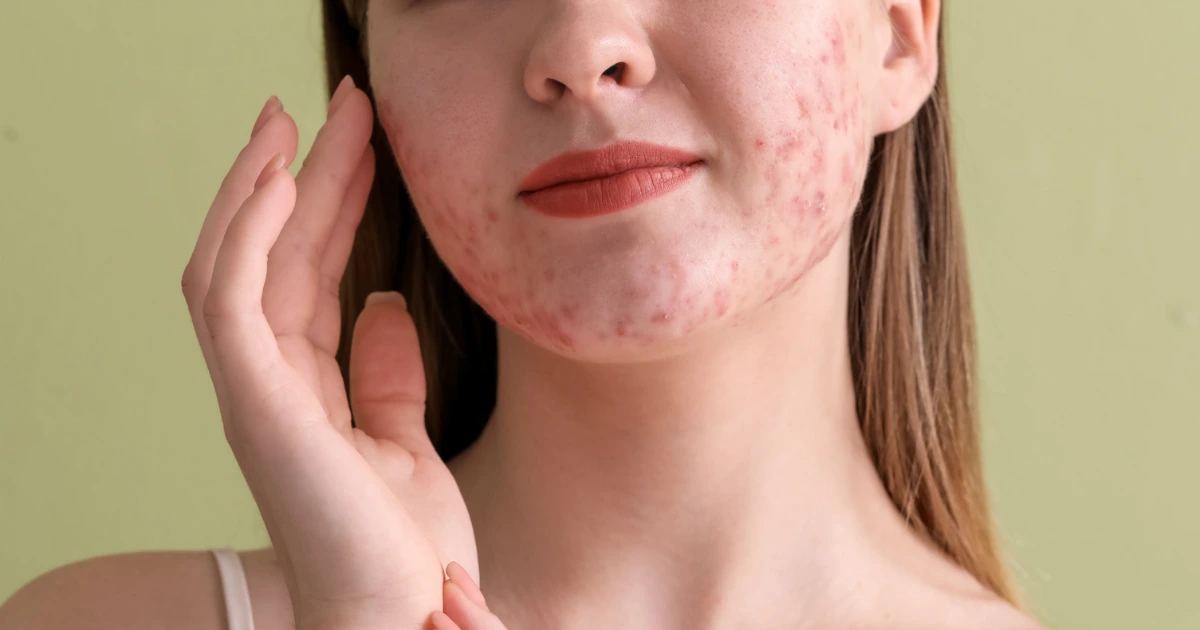 Aspire Natural Health The Naturopathic Treatment of Acne Featured Image
