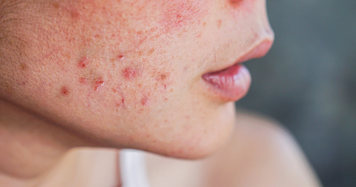 Naturopathic dermatology addresses acne by uncovering underlying causes such as hormonal imbalances, stress and diet to promote long-term skin health naturally