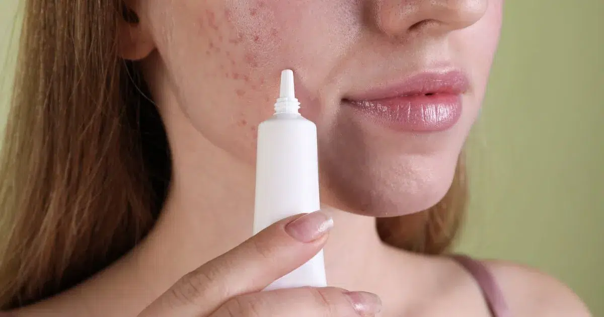 aspire-natural-health-Benzoyl-Peroxide-for-Acne_-Benefits,-Risks-and-Natural-Alternatives-1