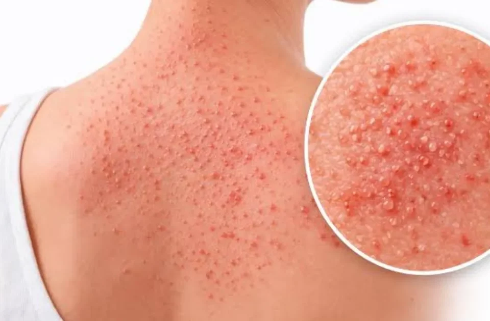 heat rash symptoms, heat rash on face
