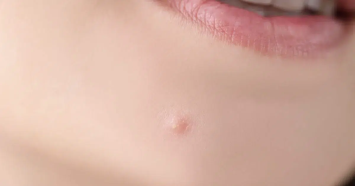 aspire-natural-health-Natural-Acne-Treatment_-A-Naturopathic-Approach-1