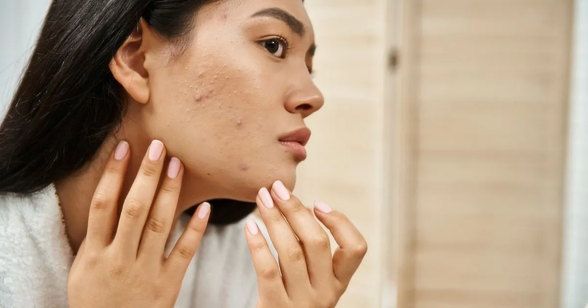 Acne Blemishes, hormonal imbalance
