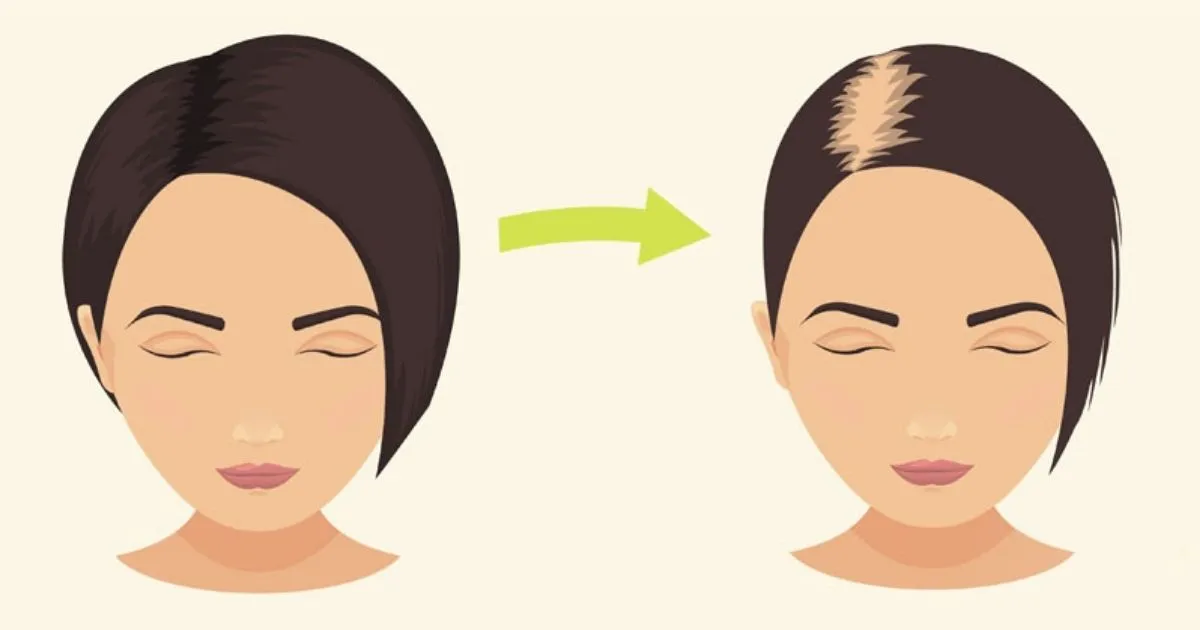 thyroid hair loss